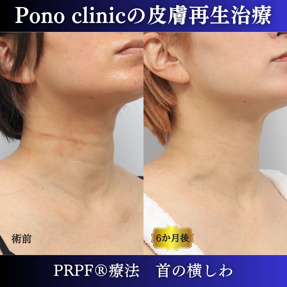 首のシワ、しわ治療、PRPF®、30代の症例 (1)