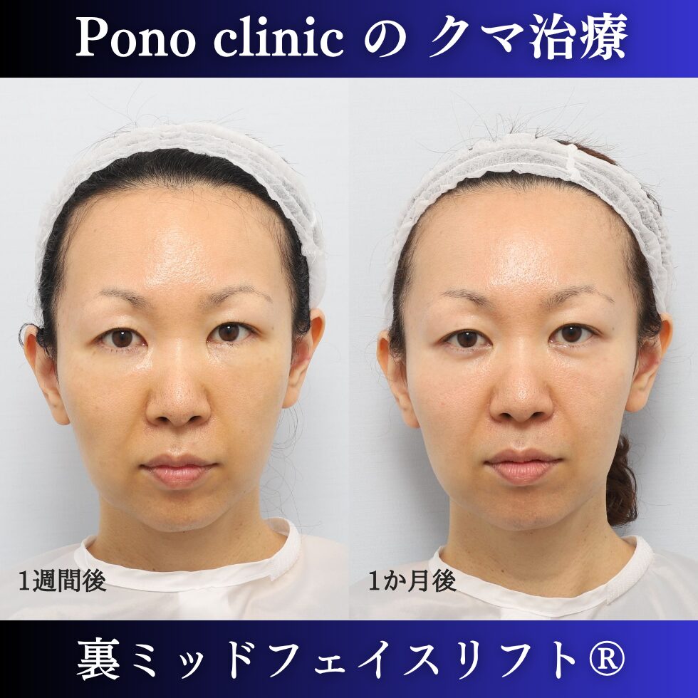 40代女性の裏ミッドフェイスリフト術後1週間と術後1か月の経過比較