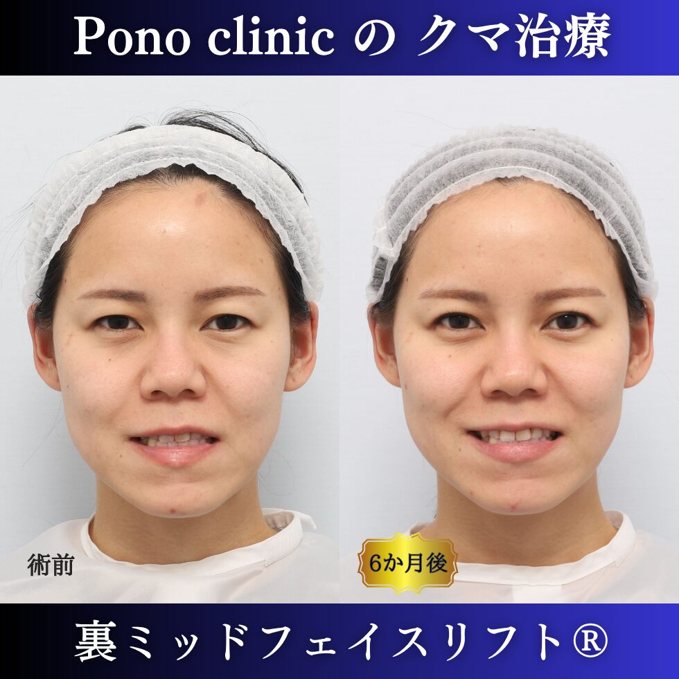 20代女性の裏ミッドフェイスリフト術前と術後6か月の笑顔比較
