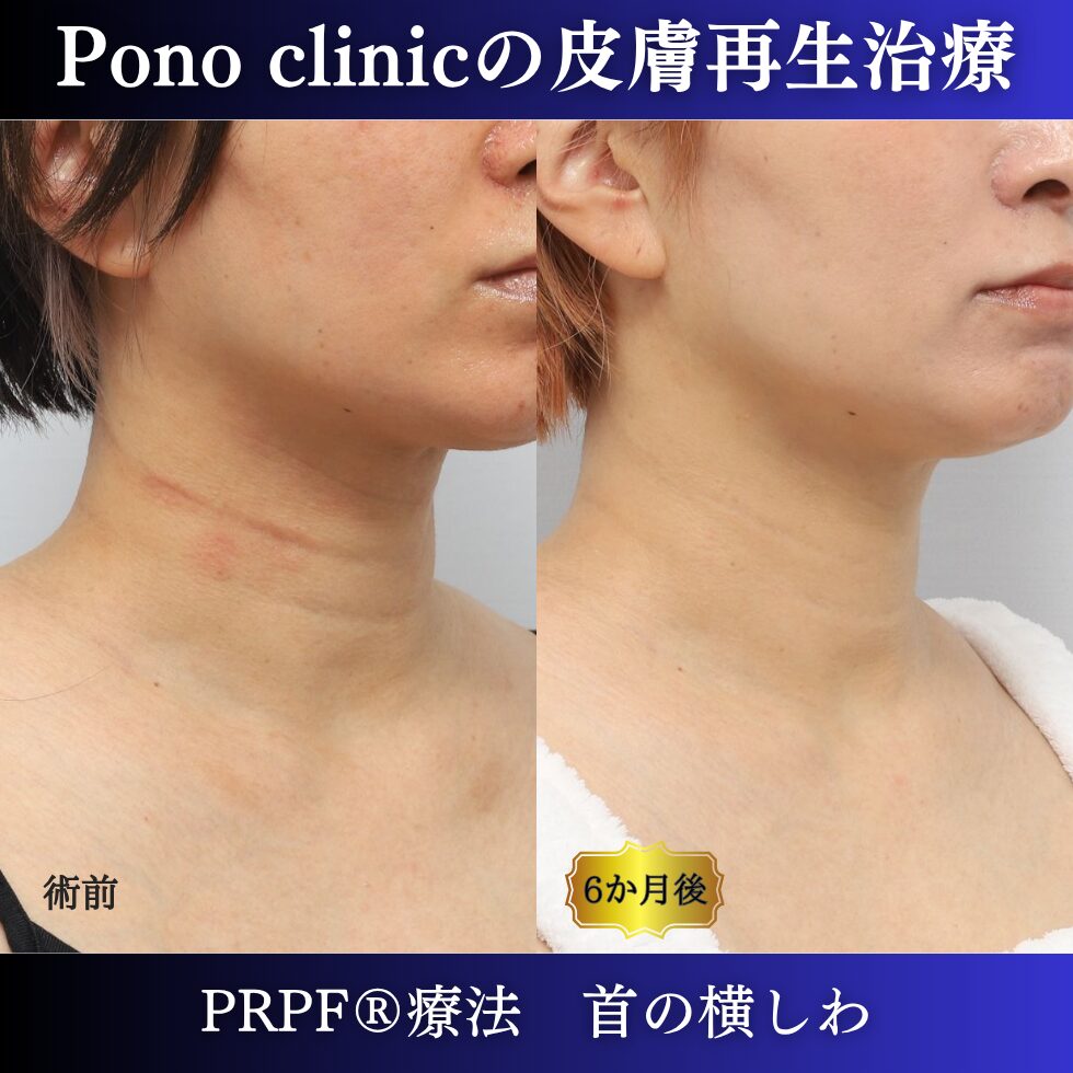 首のシワ、しわ治療、PRPF®、30代の症例 (2)