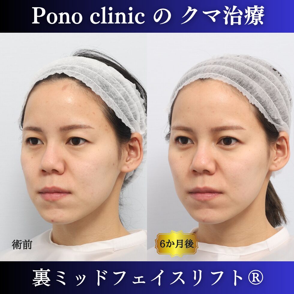 20代女性の裏ミッドフェイスリフト術前と術後6か月の左斜位比較