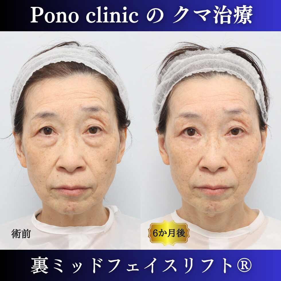 60代女性の裏ミッドフェイスリフト症例 正面 左が術前 右が術後 目の下から頬までの影の改善