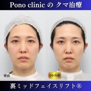 裏ミッドフェイスリフト®、目の下のクマ治療、裏ハムラ、骨膜下リフト、30代の症例 (6)
