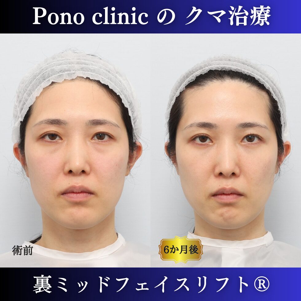 裏ミッドフェイスリフト®、目の下のクマ治療、裏ハムラ、骨膜下リフト、30代の症例 (6)