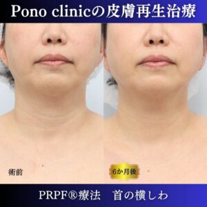首のしわ、しわ治療、 50代の症例 (4)