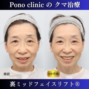 クマ治療、裏ミッドフェイスリフト、裏ハムラ、骨膜下リフト、60代の症例 (4)