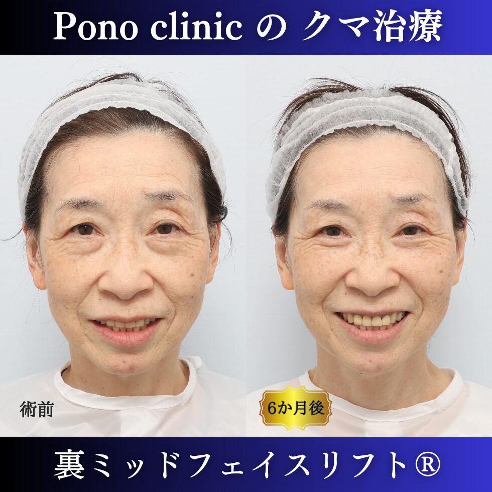 クマ治療、裏ミッドフェイスリフト、裏ハムラ、骨膜下リフト、60代の症例 (4)
