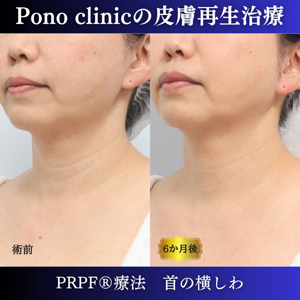 首のしわ、しわ治療、 50代の症例 (2)