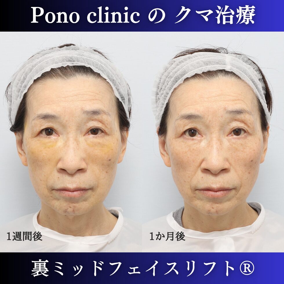 裏ミッドフェイスリフト術後経過 60代女性 左が1週間 右が1か月 腫れとむくみの変化