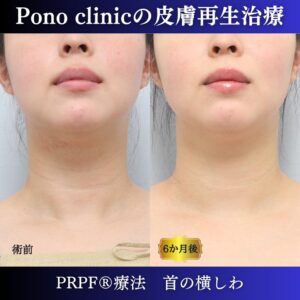 首のしわ、シワ治療、PRPF®療法、30代の症例 (6)