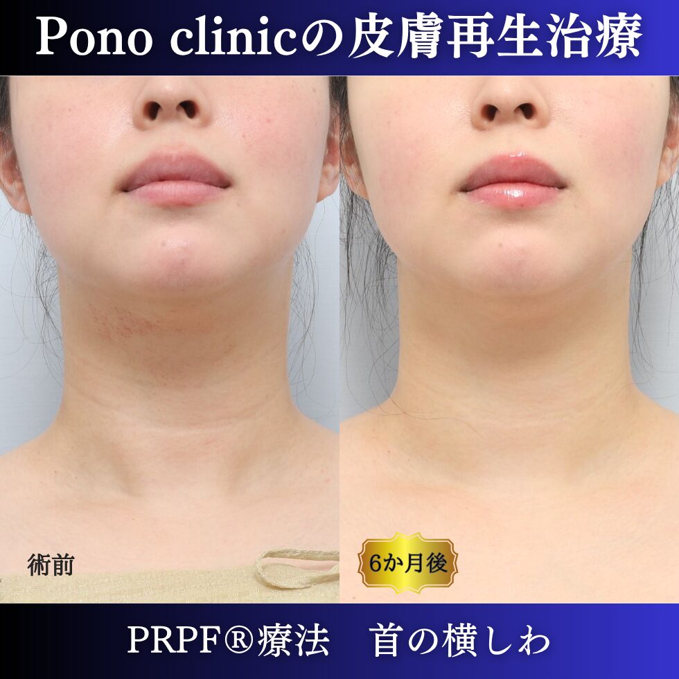 首のしわ、シワ治療、PRPF®療法、30代の症例 (6)