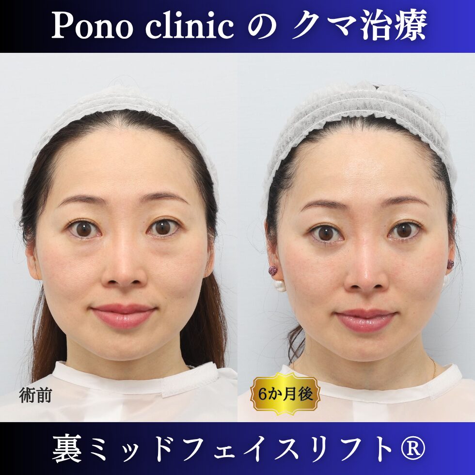 クマ治療、裏ミッドフェイスリフト、裏ハムラ、骨膜下リフト、40代の症例 (7)