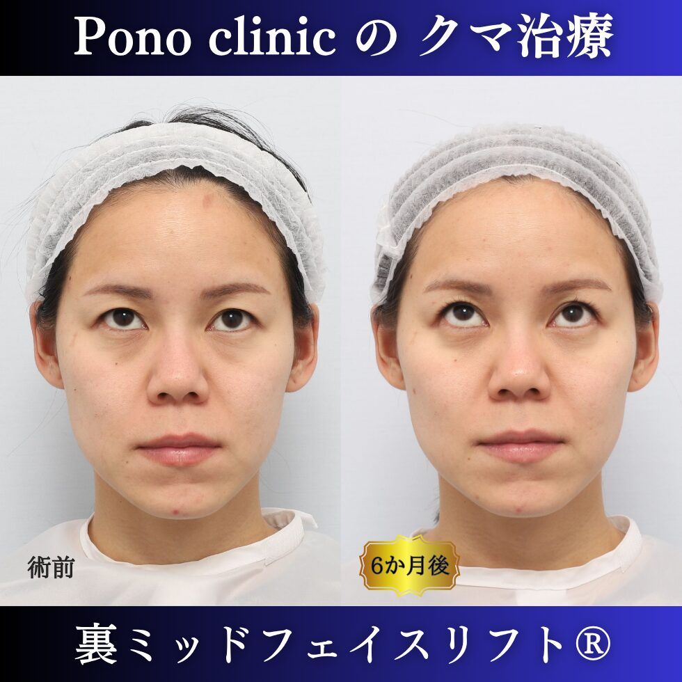 20代女性の裏ミッドフェイスリフト術前と術後6か月の上方視比較