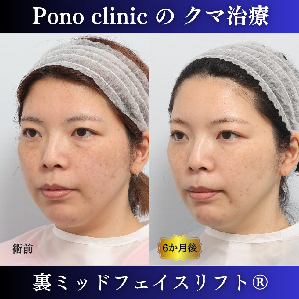 目の下のクマ治療、裏ハムラ、骨膜下リフト、裏ミッドフェイスリフト®、30代の症例(3)