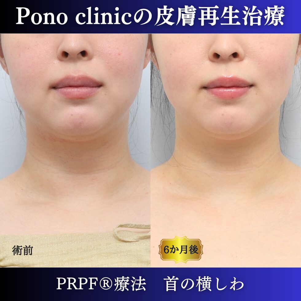 首のしわ、シワ治療、PRPF®療法、30代の症例 (7)