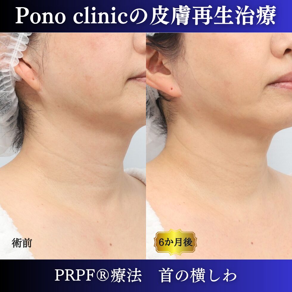 首のしわ、しわ治療、 50代の症例 (1)