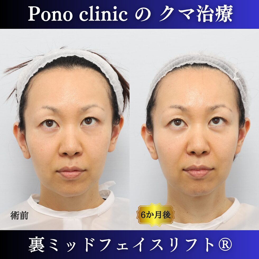 40代女性の裏ミッドフェイスリフト術前と術後6か月の上方視比較