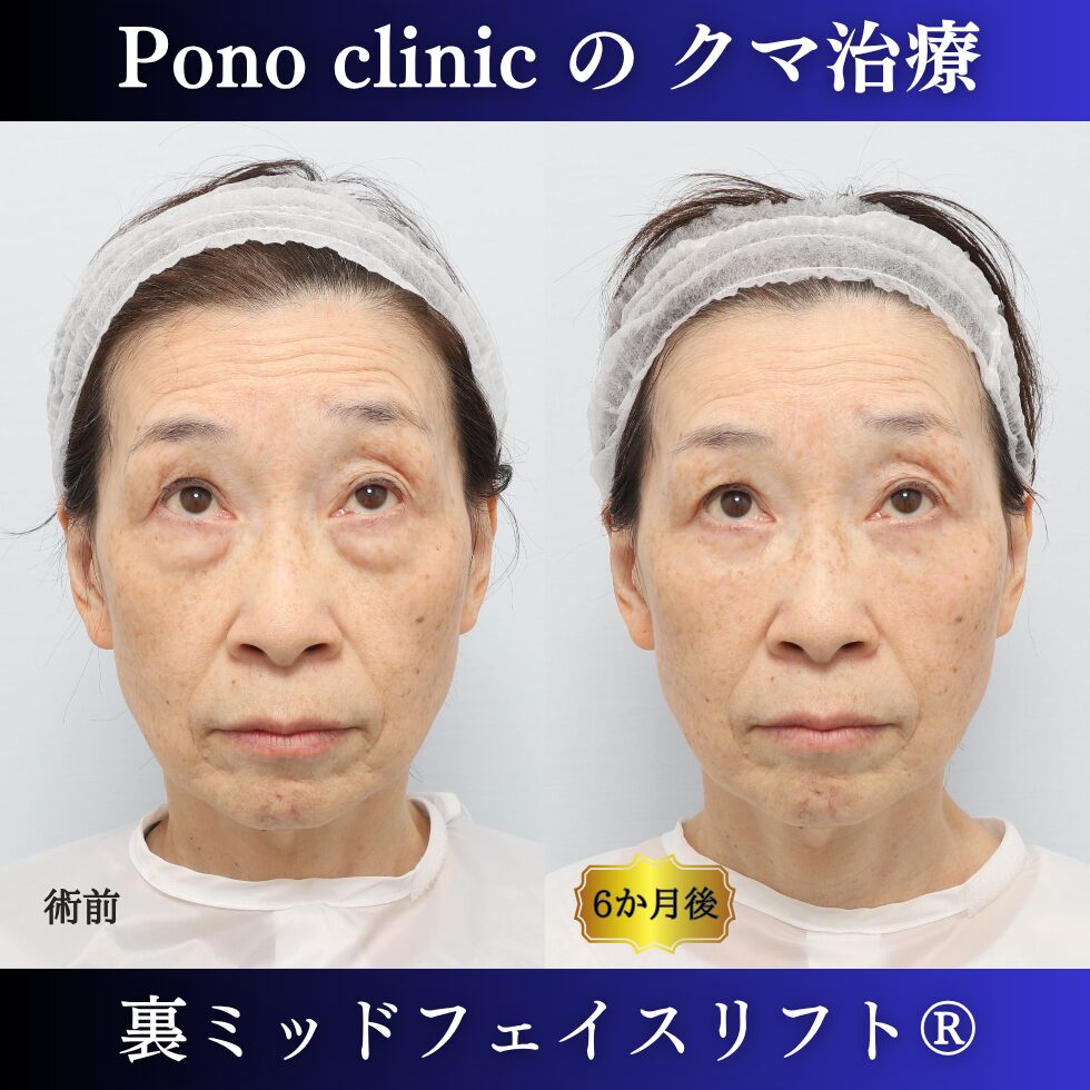 60代女性の裏ミッドフェイスリフト症例 上方視 左が術前 右が術後 眼窩脂肪のふくらみと影の変化