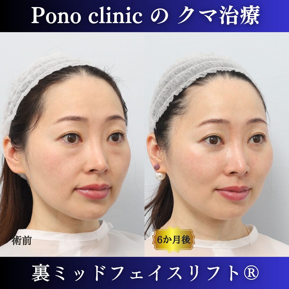 クマ治療、裏ミッドフェイスリフト、裏ハムラ、骨膜下リフト、40代の症例 (2)