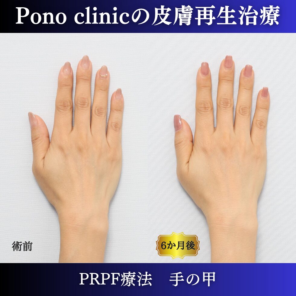 手の甲の若返り、手の甲のゴツゴツ感、PRPF療法 、50代の症例 (6)