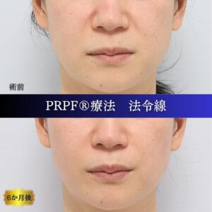 しわ治療、法令線、鼻翼基部、笑いじわ、PRPF療法、40代の症例 (4)