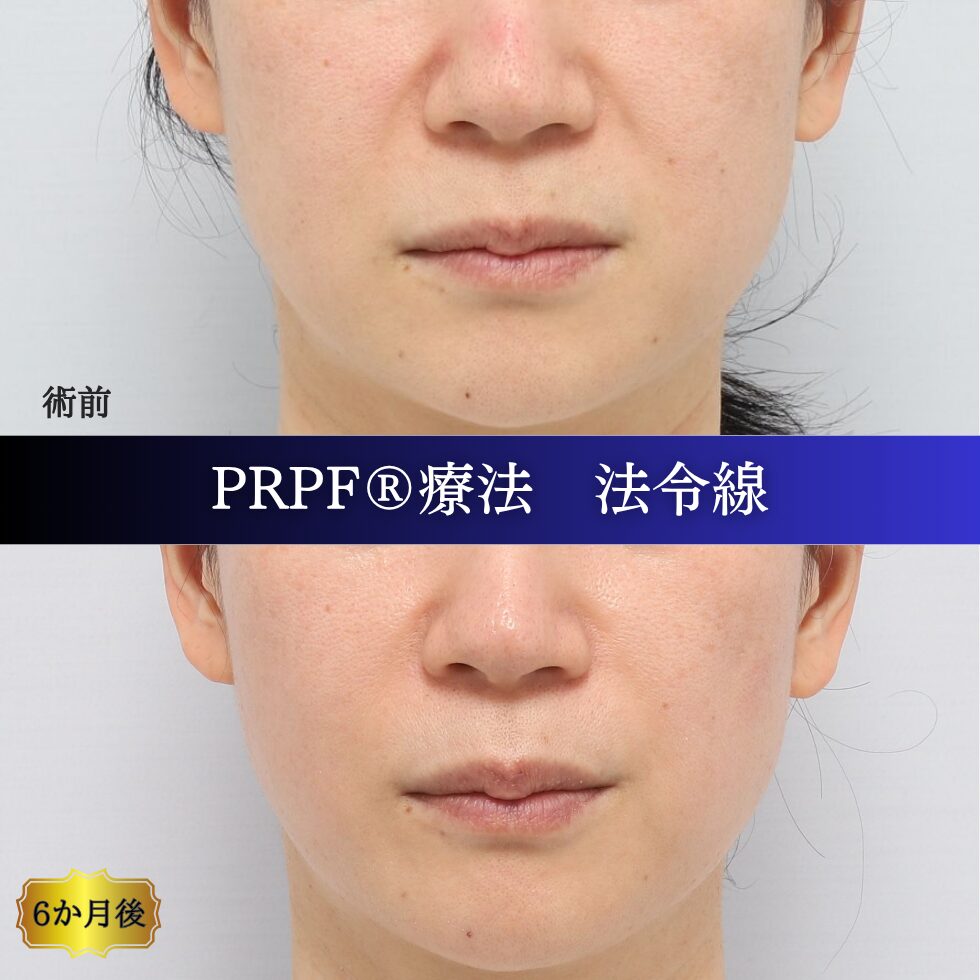 しわ治療、法令線、鼻翼基部、笑いじわ、PRPF療法、40代の症例 (4)