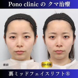 クマ治療、裏ハムラ、骨膜下リフト、裏ミッドフェイスリフト、20代の症例 (7)