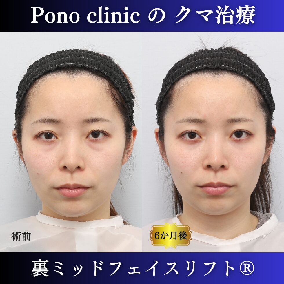 クマ治療、裏ハムラ、骨膜下リフト、裏ミッドフェイスリフト、20代の症例 (7)