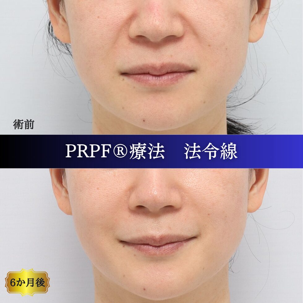 しわ治療、法令線、鼻翼基部、笑いじわ、PRPF療法、40代の症例 (3)