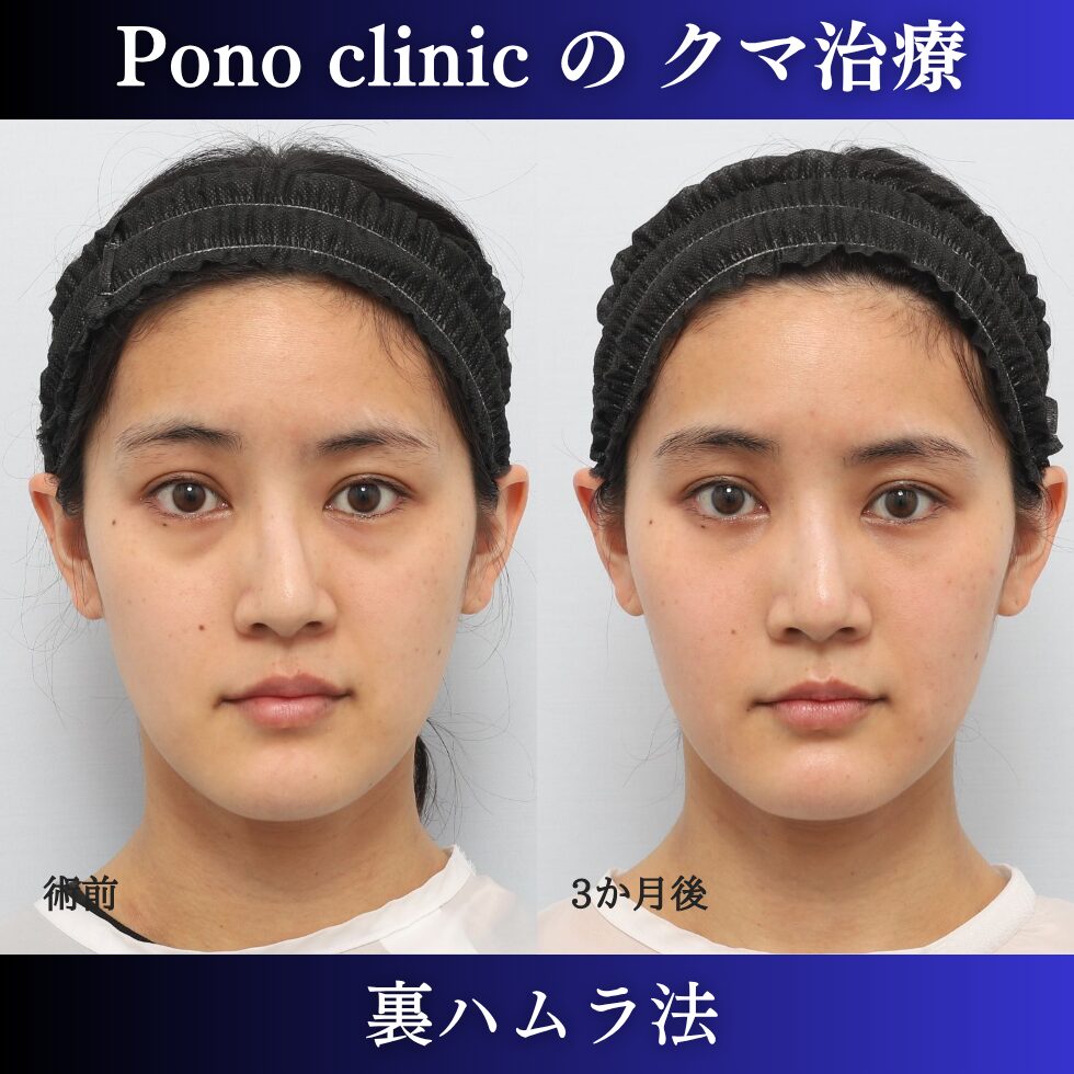 目の下のクマ取り、クマ治療、裏ハムラ法、20代女性の症例 (7)