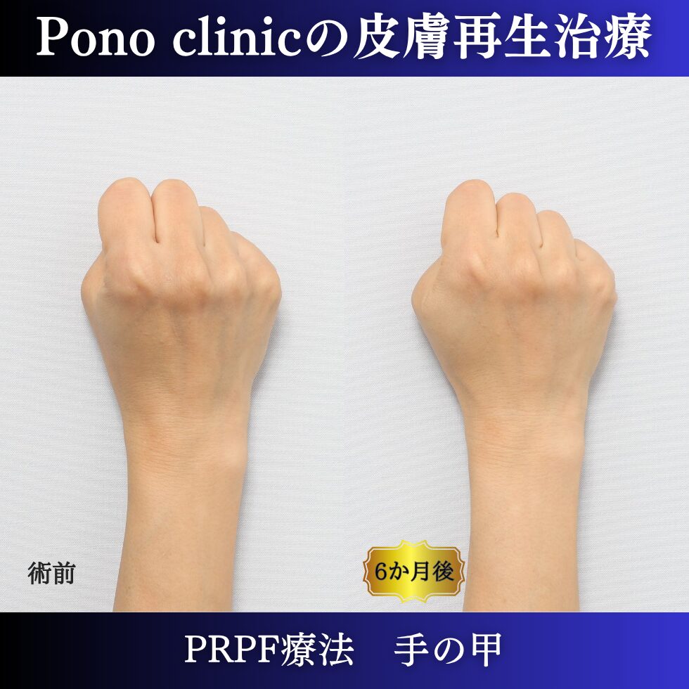 手の甲の若返り、手の甲のゴツゴツ感、PRPF療法 、50代の症例 (4)