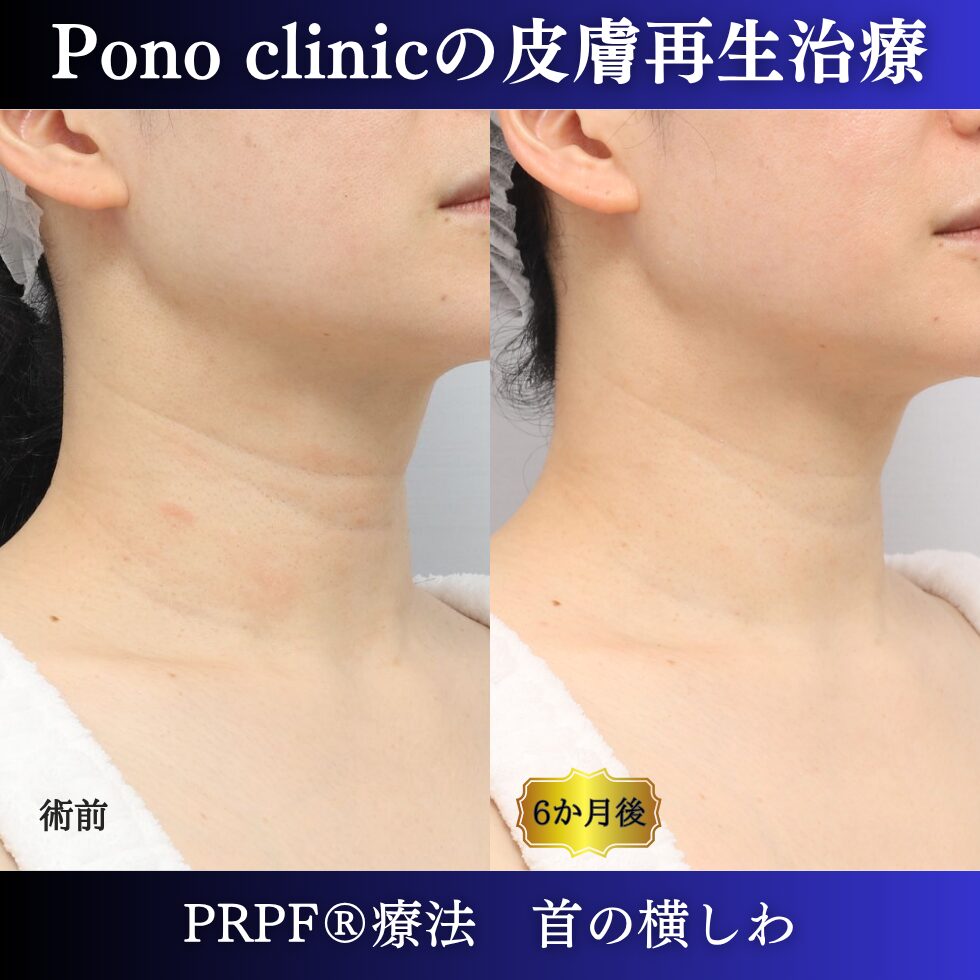 首のしわ、PRPF療法、40代の症例 (1)