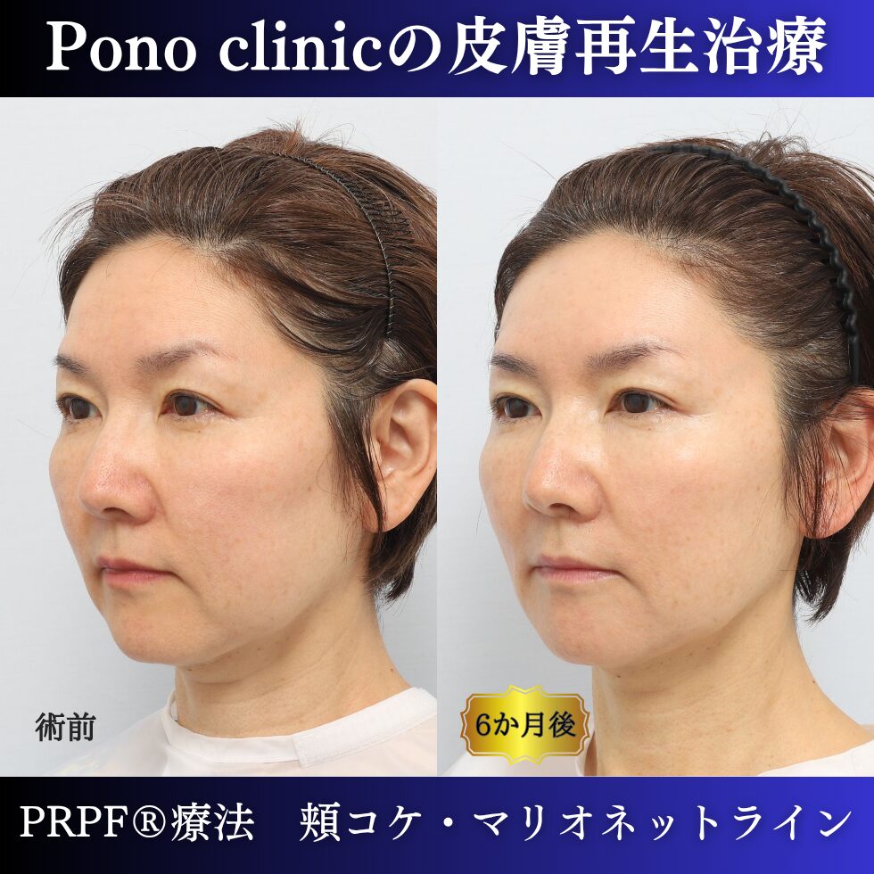 しわ治療、PRPF療法、マリオネットライン、頬コケ、50代の症例 (3)
