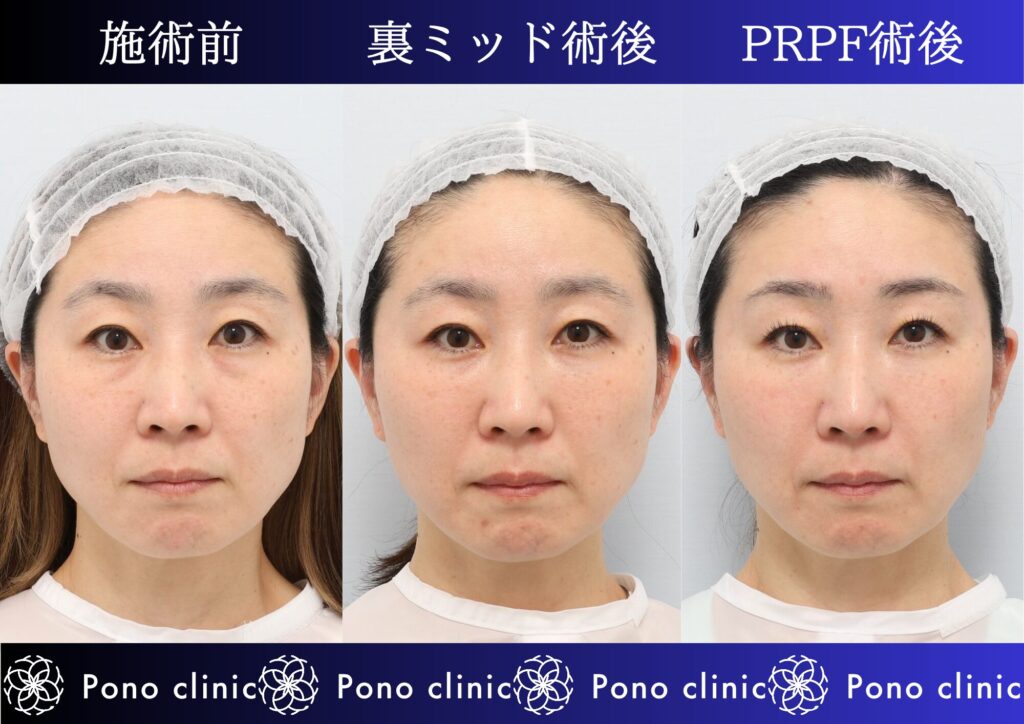 クマ治療、目の下のクマ、裏ハムラ、骨膜下リフト、裏ミッドフェイスリフト、PRPF療法 (3)