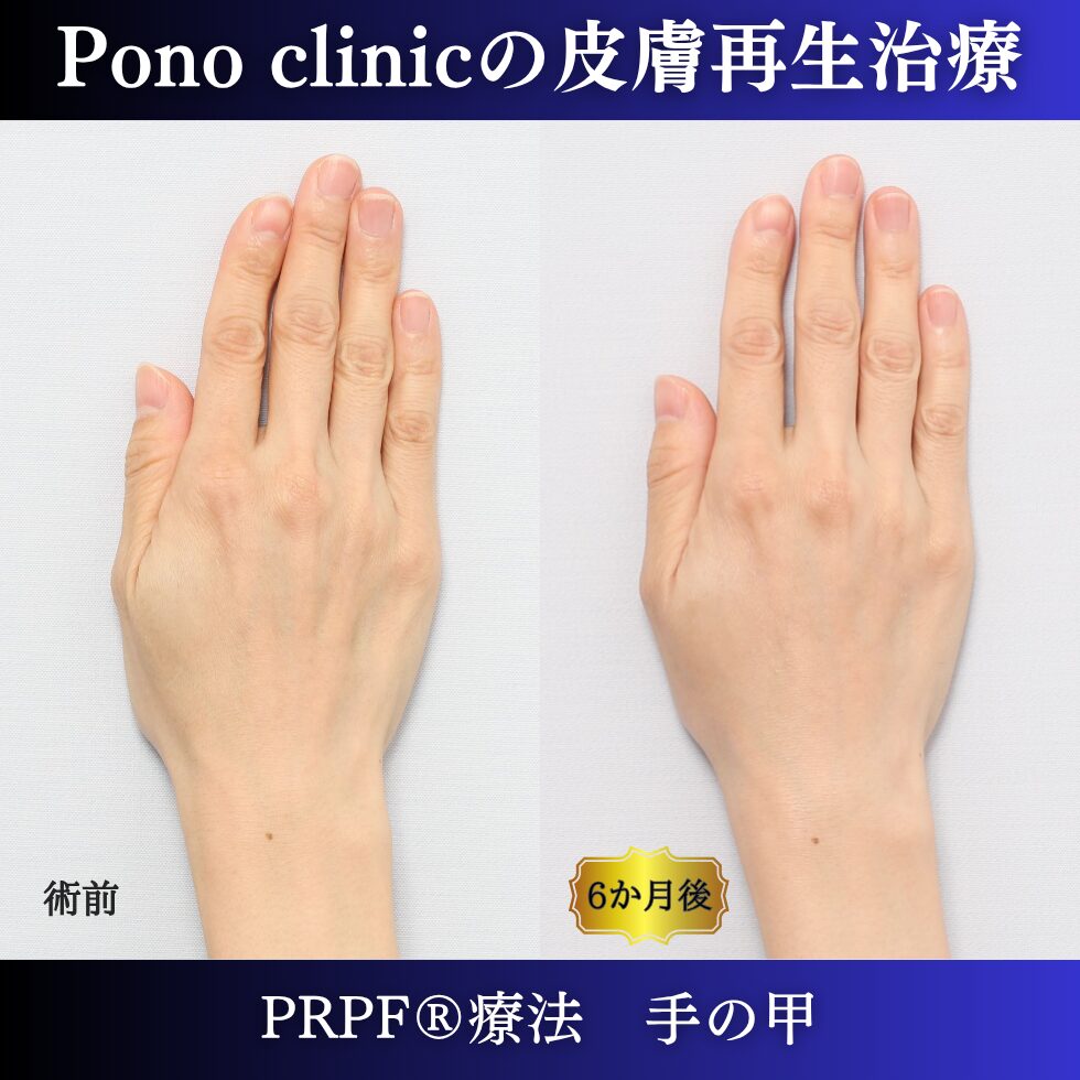 手の甲のゴツゴツ感、手の甲の若返り、PRPF療法、 40代の症例 (5)