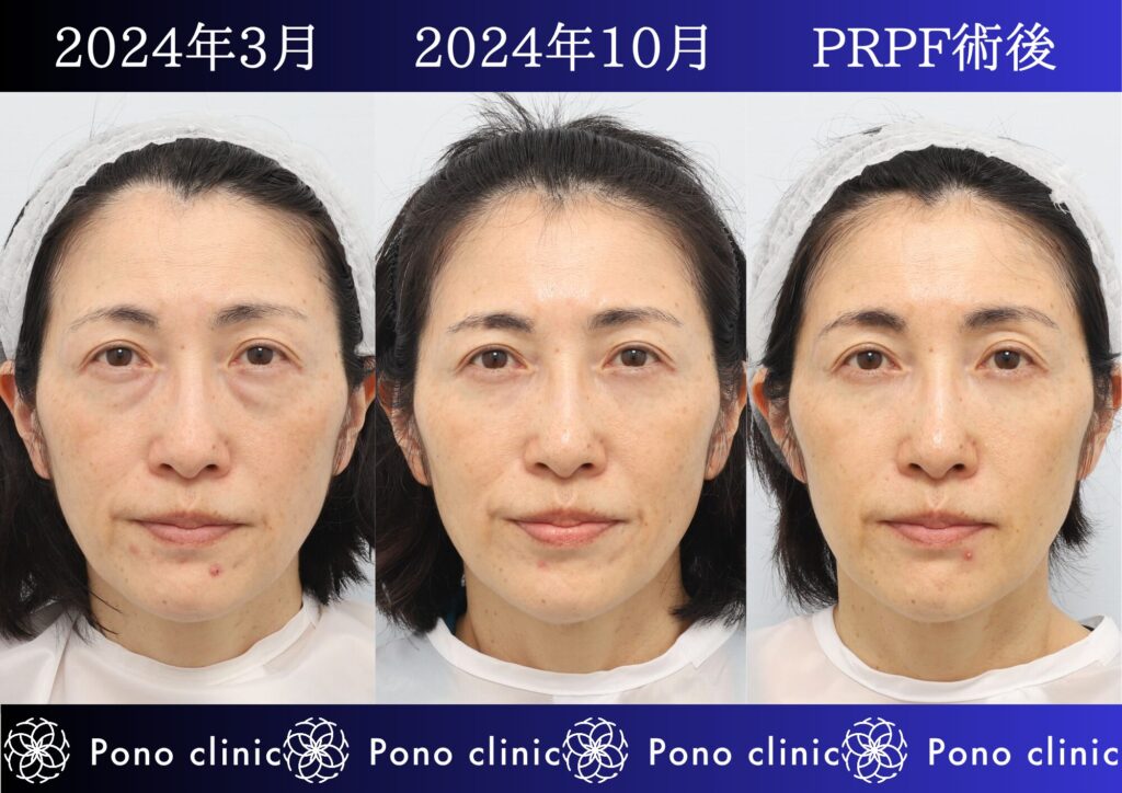クマ治療、目の下のクマ、裏ハムラ、骨膜下リフト、裏ミッドフェイスリフト、PRPF療法 (2)