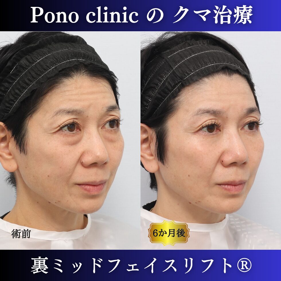 50代女性の裏ミッドフェイスリフト術前と術後6か月の右斜位比較