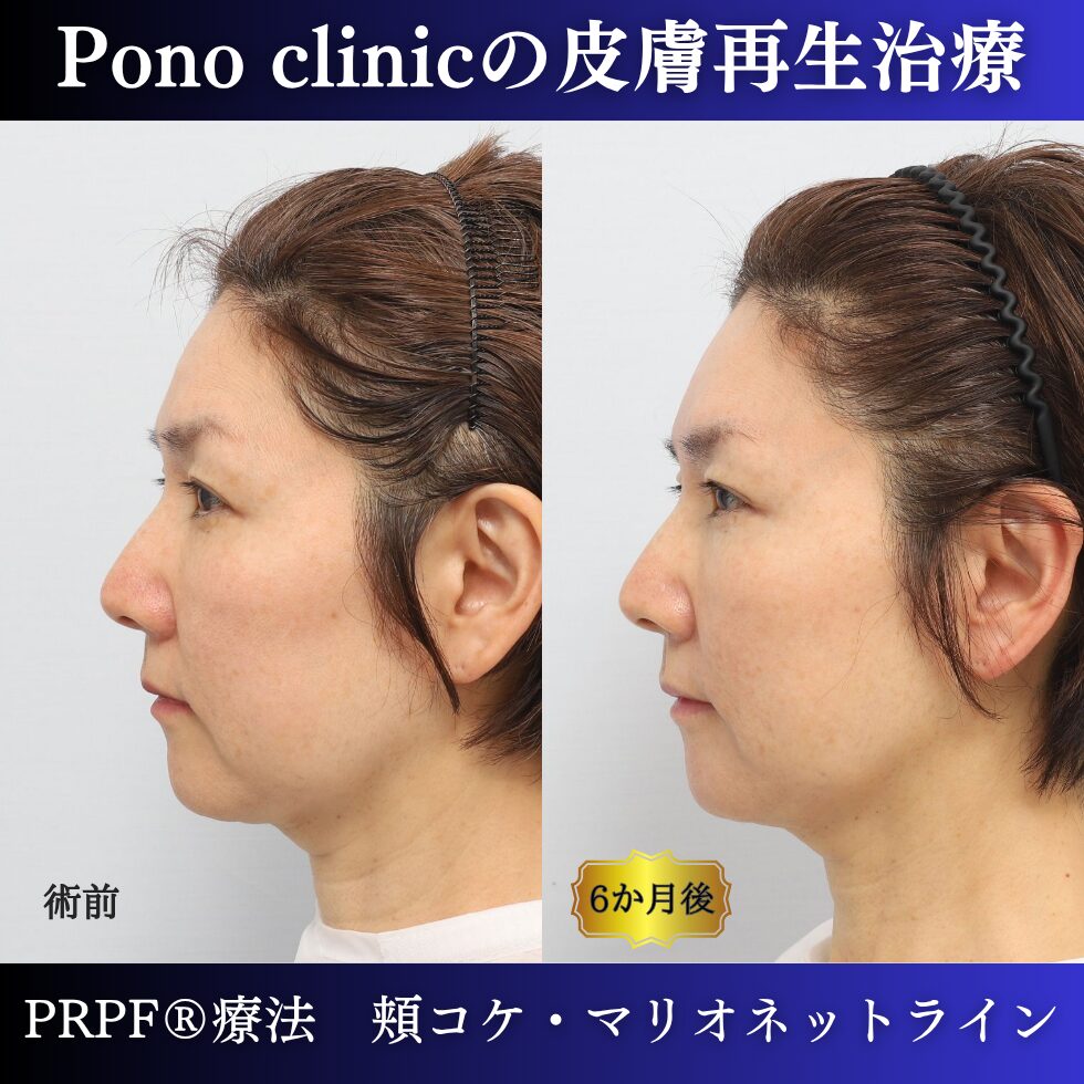 しわ治療、PRPF療法、マリオネットライン、頬コケ、50代の症例 (4)