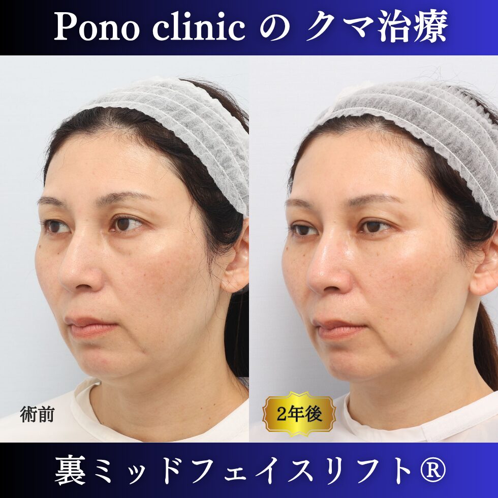 裏ミッドフェイスリフト、裏ハムラ法、骨膜下リフト、クマ治療、40代の症例、長期経過 (2)
