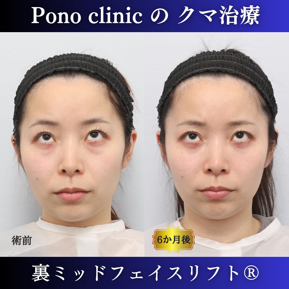 20代女性の裏ミッドフェイスリフト術前と術後6か月の上方視比較