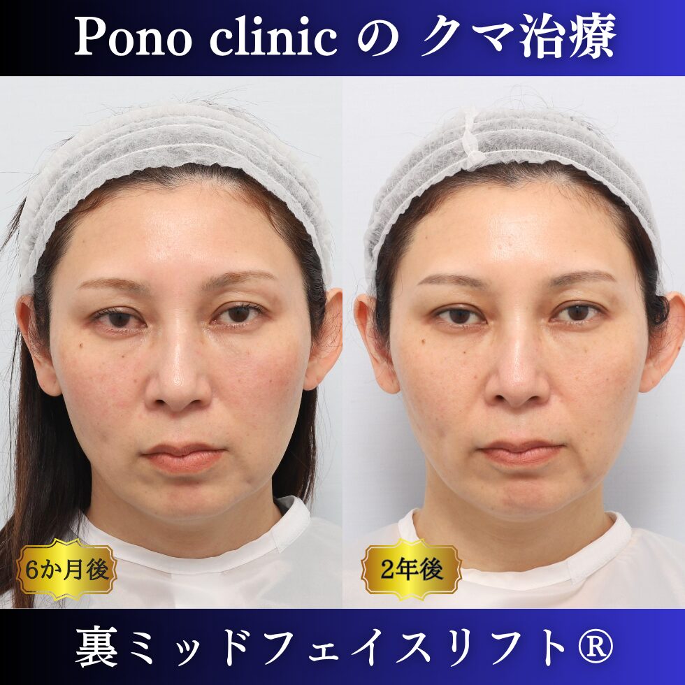 裏ミッドフェイスリフト、裏ハムラ法、骨膜下リフト、クマ治療、40代の症例、長期経過 (7)