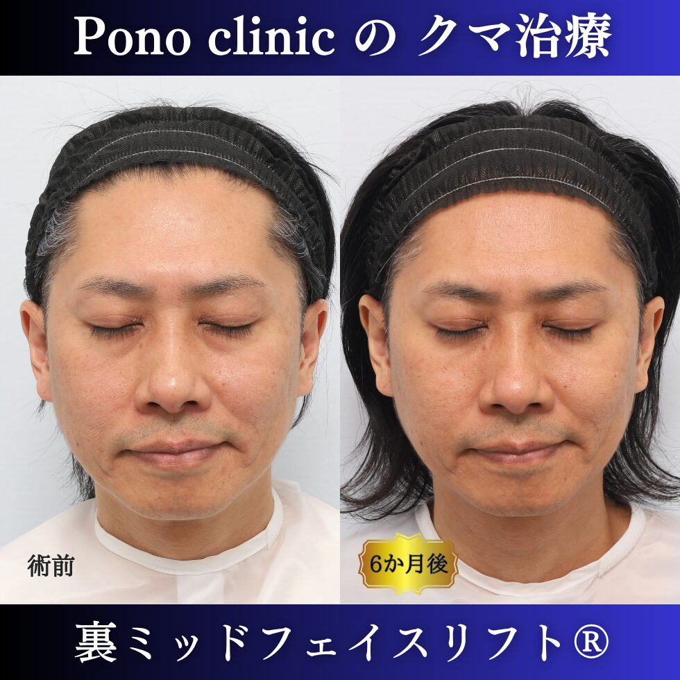 40代男性の裏ミッドフェイスリフト術前と術後6か月の閉眼比較