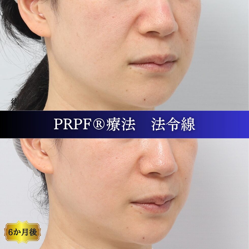 しわ治療、法令線、鼻翼基部、笑いじわ、PRPF療法、40代の症例 (1)