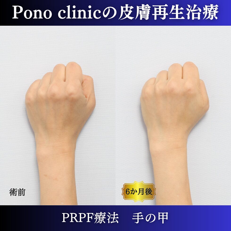 手の甲の若返り、手の甲のゴツゴツ感、PRPF療法 、50代の症例 (1)
