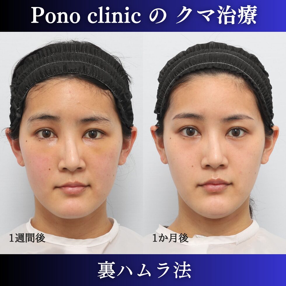 目の下のクマ取り、クマ治療、裏ハムラ法、20代女性の症例 (1)