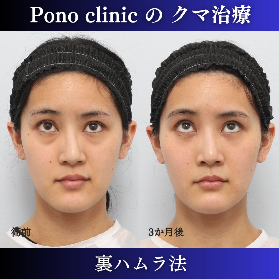 目の下のクマ取り、クマ治療、裏ハムラ法、20代女性の症例 (4)