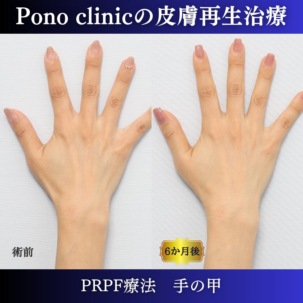 手の甲の若返り、手の甲のゴツゴツ感、PRPF療法 、50代の症例 (5)