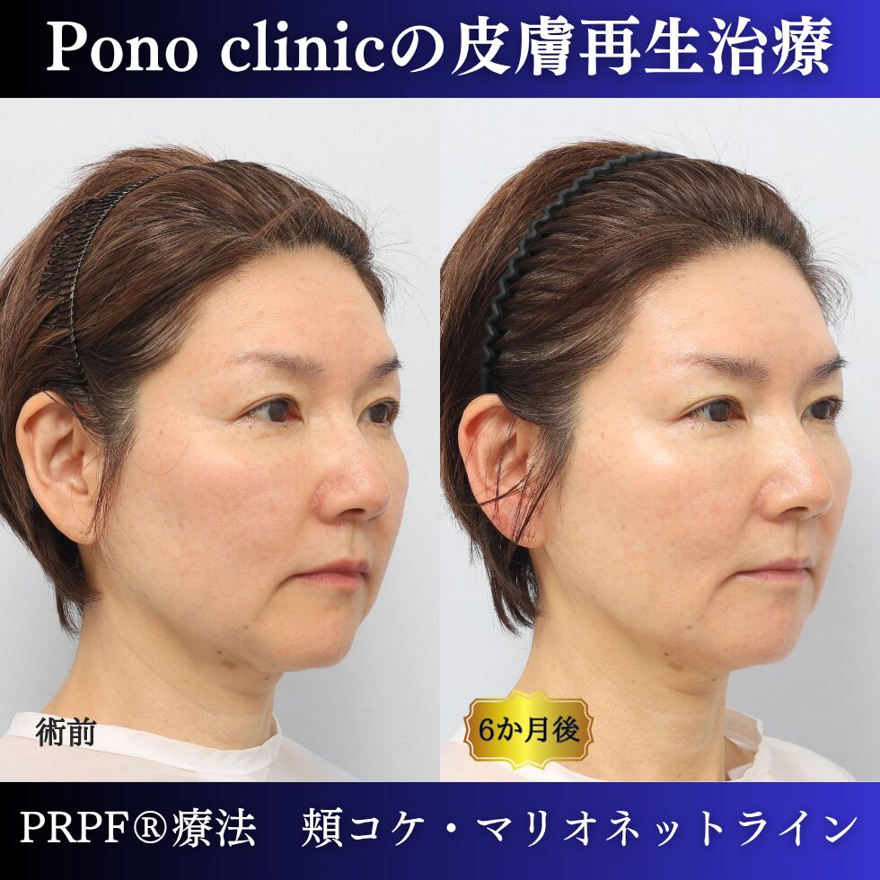 しわ治療、PRPF療法、マリオネットライン、頬コケ、50代の症例 (1)