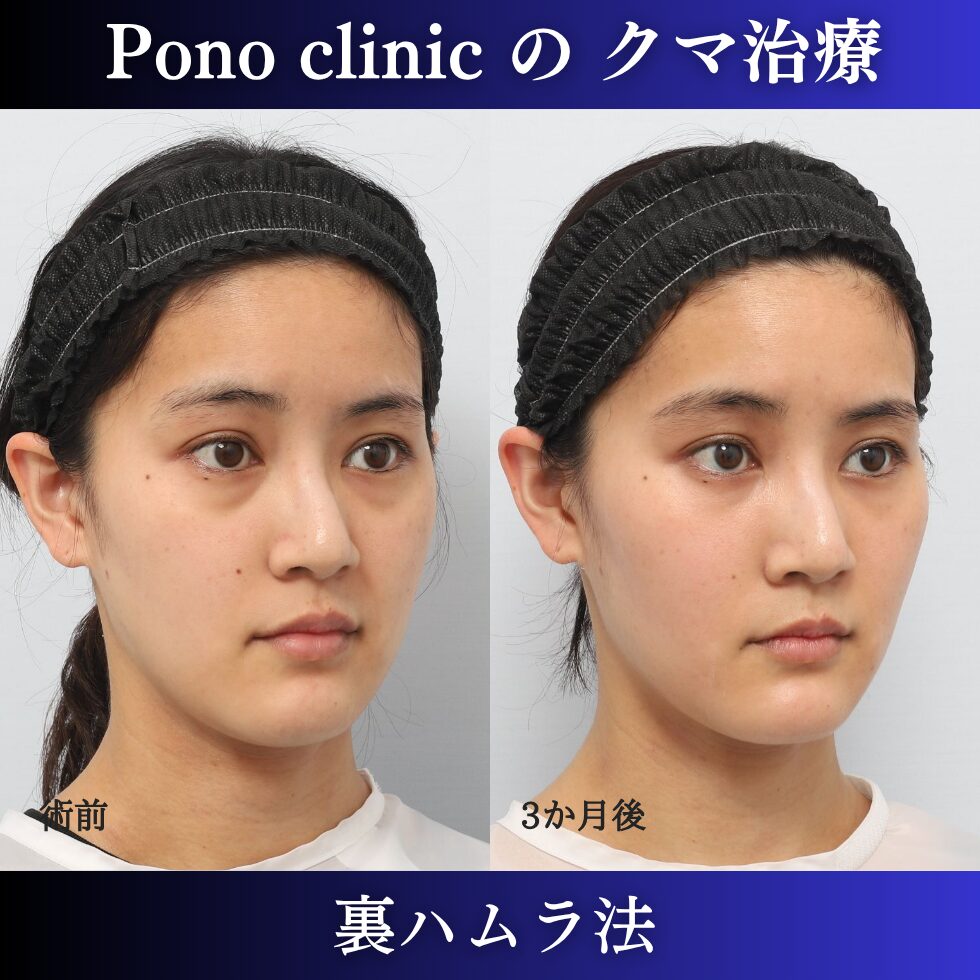 目の下のクマ取り、クマ治療、裏ハムラ法、20代女性の症例 (2)