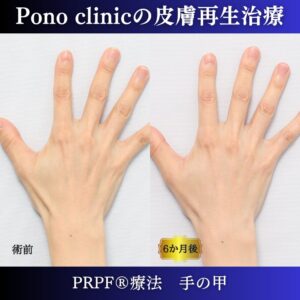 手の甲のゴツゴツ感、手の甲の若返り、PRPF療法、 40代の症例 (4)
